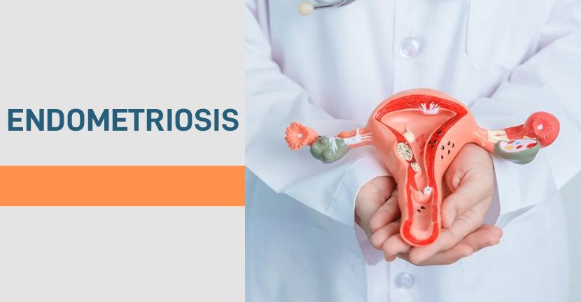 Endometriosis, en preguntas